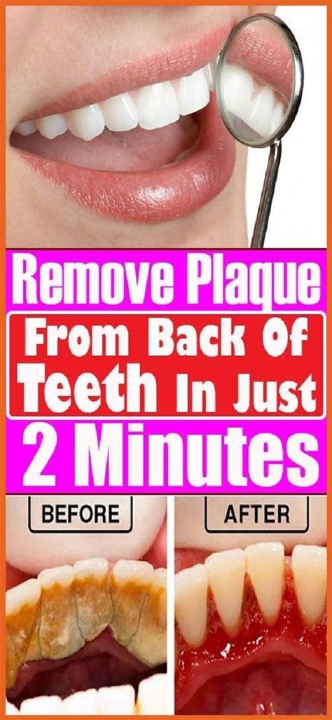 Review Of How To Remove Teeth Tartar References - Ecoged