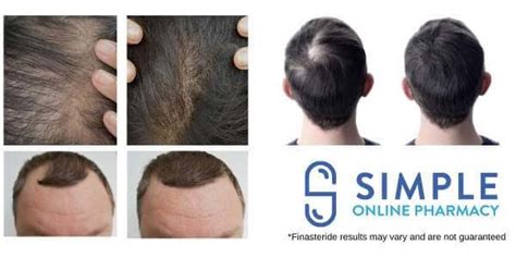 Finasteride Before After