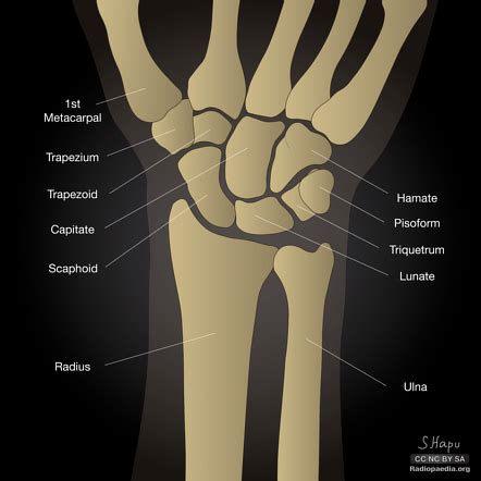 Carpal Bones Xray