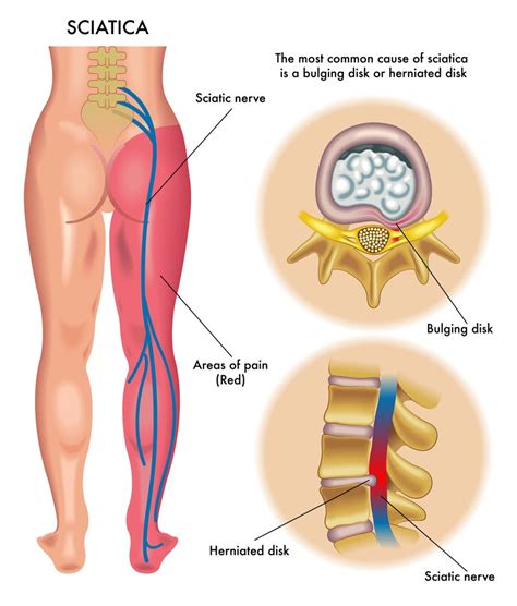 What causes sciatica and which treatments can stop the pain