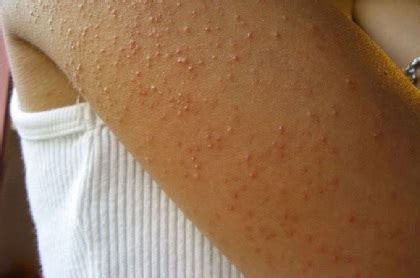 Keratosis Pilaris Treatment, Causes & Symptoms