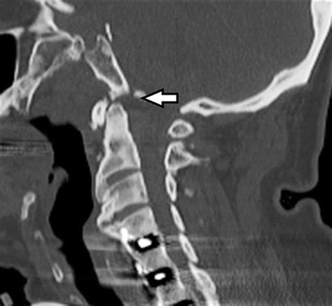 Atlanto Occipital Joint Xray