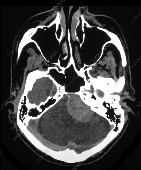 MRI Large Acoustic Schwannoma (Vestibular Schwannoma) - Stock Image ...