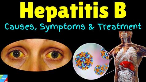 Hepatitis B – Symptoms, Causes, Risk Factors, Pathophysiology ...