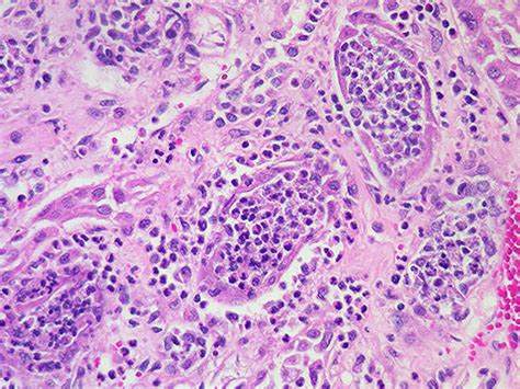 Pyelonephritis histology | Medical education, Celestial bodies, Nebula