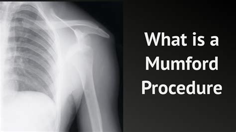 What is a Mumford Procedure - YouTube