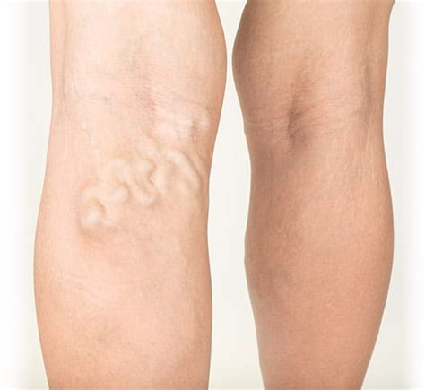 Varicose Veins - Symptoms, Causes & Conditions | Vein Health