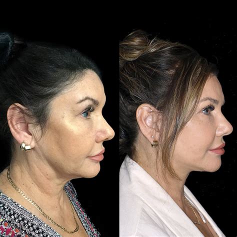 Facelift vs Thread Lift | What's the difference?