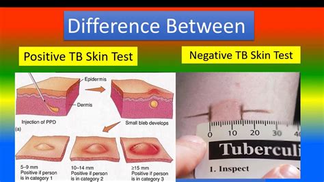 Ppd Test Results Form