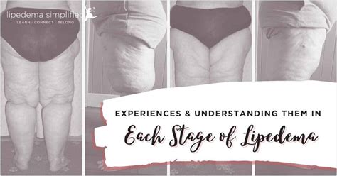 Stages of Lipedema: Understanding the Experiences of Patients