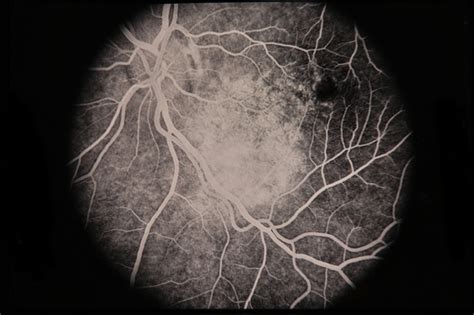 Choroidal Hemangioma - Retina Image Bank