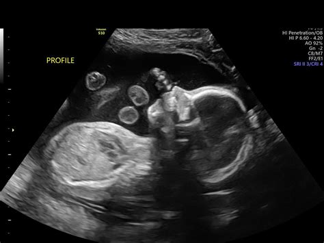 23 Week Fetus