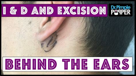 Inflamed and Non-Inflamed Cyst Removals, Behind Ears - YouTube