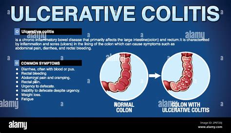 Ulcerative Colitis Symptoms Infographic illustration Stock Vector Image ...