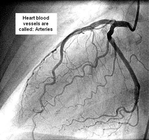 Coronary Angiography Anatomy - Anatomy Book