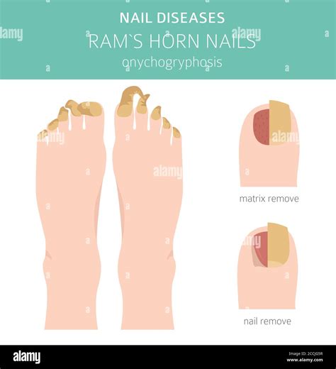 Nail diseases. Onychogryphosis, Ram`s horn nail. Medical infographic ...