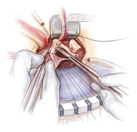 Minimally Invasive Aortic Valve Replacement | Dr Andrie Stroebel - Gold ...