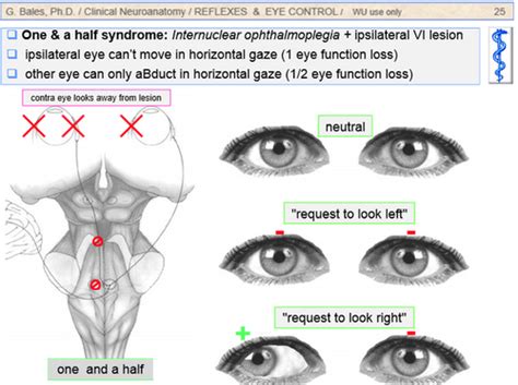 Conjugate Gaze Flashcards | Quizlet