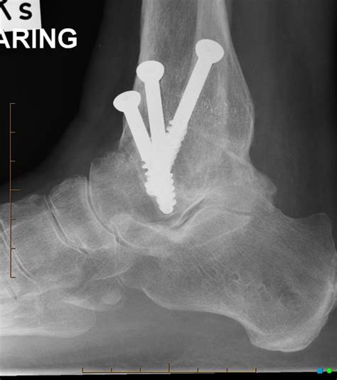 Ankle Arthrodesis | Bone and Spine