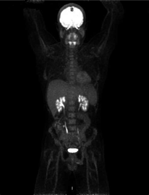 Positron emission tomography (PET) scan shows no sign of lymphoma ...