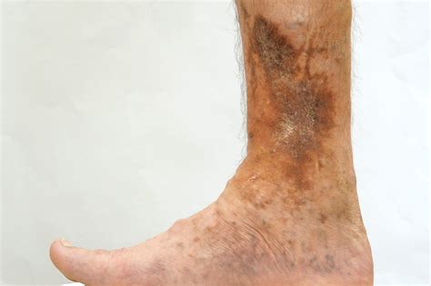 Venous Ulcers: Symptoms, Pain, and Treatment | Southern Utah Vein Center