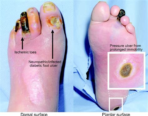 Diabetic foot ulcer pictures 1 | Symptoms and pictures