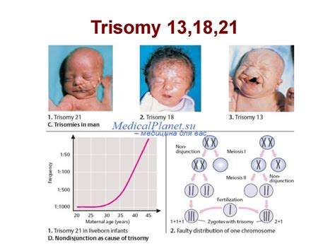 Trisomy 13Trisomy 13 on emaze