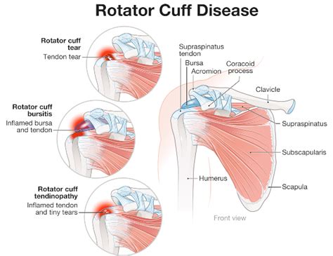 Shoulder Pain and the Rotator Cuff » OrthoGeorgia