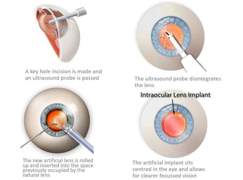 Eye Lens Replacement Surgery - Premium Lens Implant Surgery UK