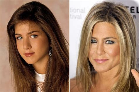 Face Plastic Surgery, Nose Surgery, Jennifer Aniston, Nose Reshaping ...