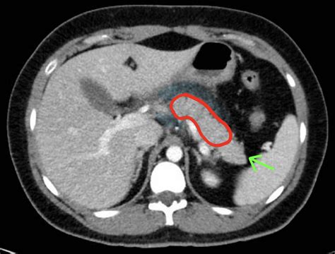 Acute Panceratitis Axial CT 2. Annotated. JETem 2019 - JETem