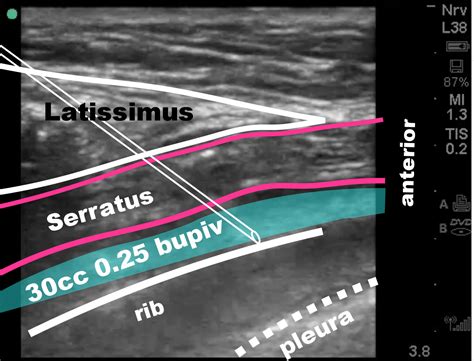 PECS/SERRATUS — Highland EM Ultrasound Fueled pain management