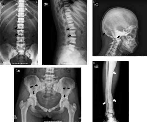 Osteoporosis X Ray Jaw