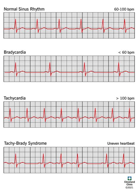 Sick Sinus Syndrome: Symptoms, Causes and Treatment.