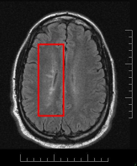 MS Pathology: Dawson’s fingers – Prof G's MS Blog Archive