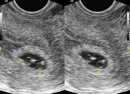 Twins Ultrasound 7 Weeks