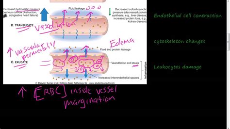 #19 - Acute Inflammation 1 of 3 - Vascular permeability, Vasodilation ...