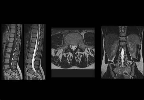 Anatomy of the lumbar vertebrae: normal anatomy | e-Anatomy