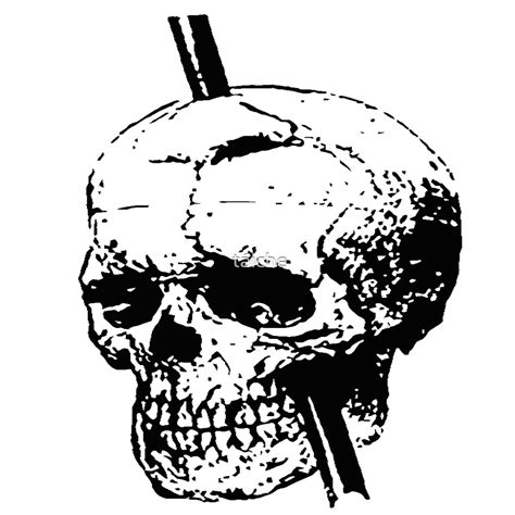 "Skull of Phineas Gage With Tamping Iron" by taiche | Redbubble