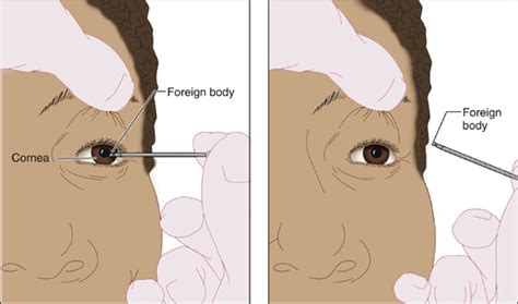 Foreign Body, Corneal | Anesthesia Key