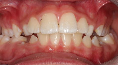 bilateral posterior crossbite case before | SNODGRASS-KING