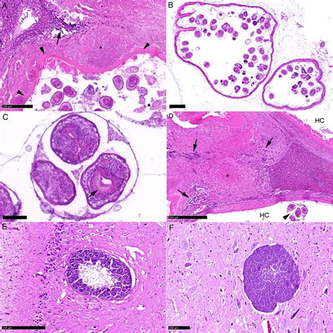 (A) Liver. Part of hydatid cyst with surrounding parenchyma. Cystic ...