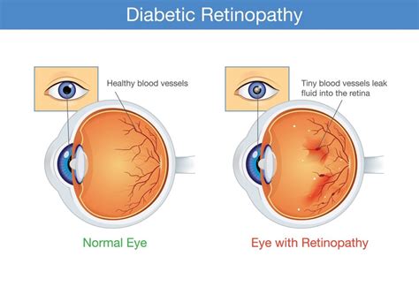 Understanding the Stages of Diabetic Retinopathy | Elman Retina Group