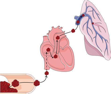 Intrapulmonary airways - Servier Medical Art