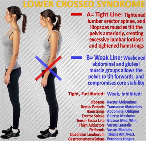 Lower crossed syndrome explained | Gluteal muscles, Abdominus rectus ...