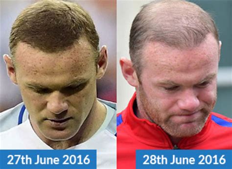 Wayne Rooney Hair Transplant Results