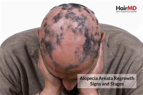 Alopecia Areata Regrowth Signs and Stages