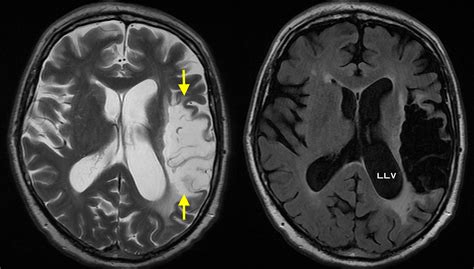 Encephalomalacia due to old MCA infarct - Radiology at St. Vincent's ...