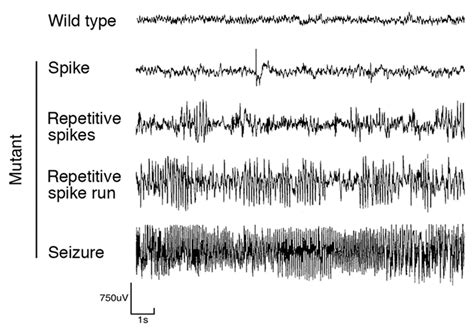 Normal Eeg Tracing