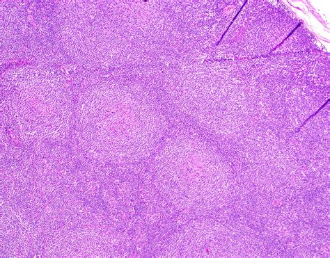 Follicular Lymphoma Pathology Outlines